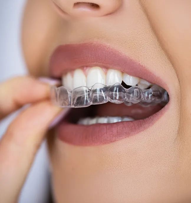 Transparente Aligner Schiene beim Einsetzen